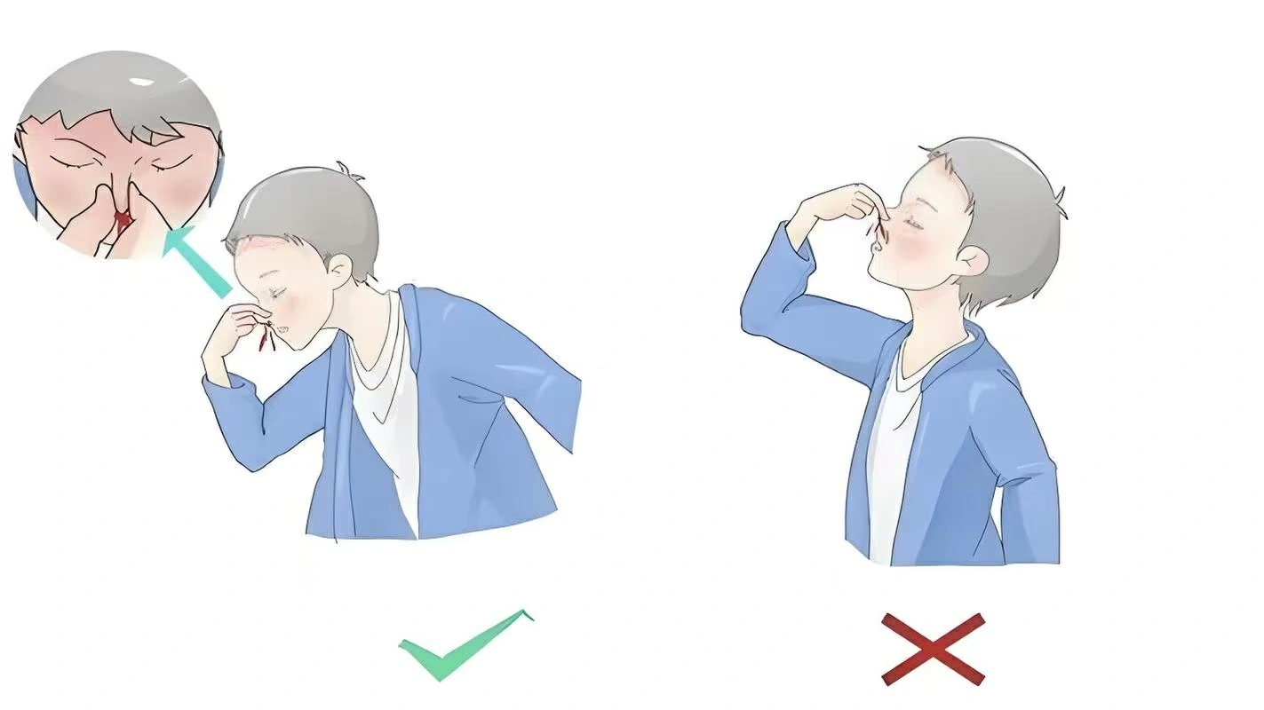 轉發提醒，流鼻血不要先仰頭！