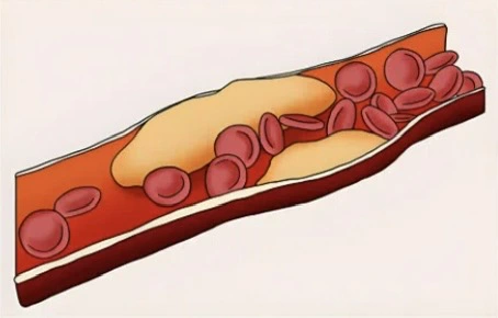 有片 |我國血脂異常人數已超4億