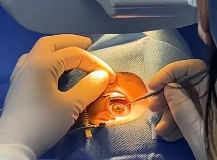 西班牙研究人員利用魚鱗研發人工角膜 