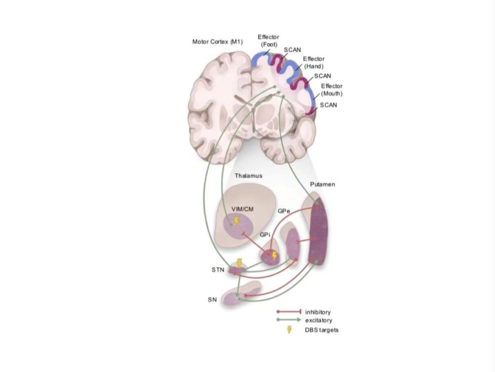 中國科學家世界首次發現帕金森病底層功能網絡機制