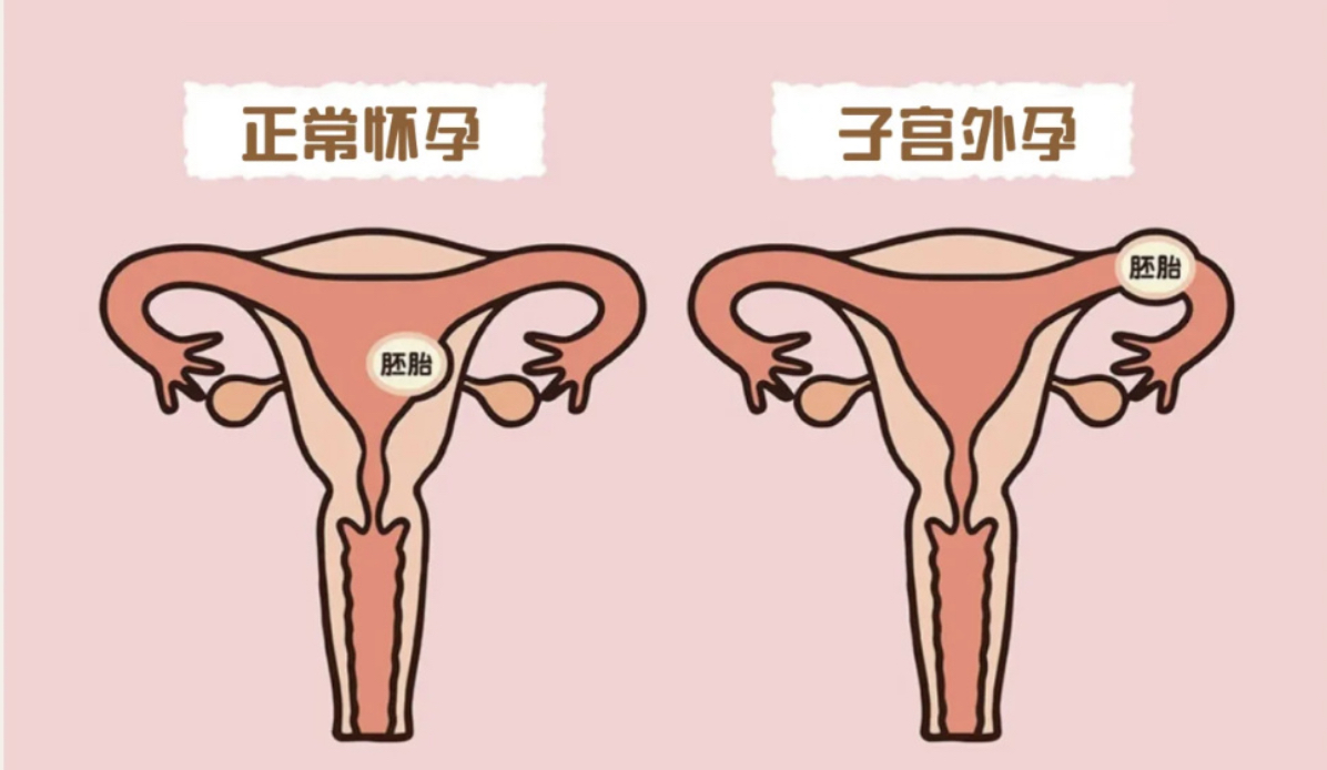 有片|深圳女子受精卵鑽入主動脈夾層 一旦破裂或將幾分鐘喪命