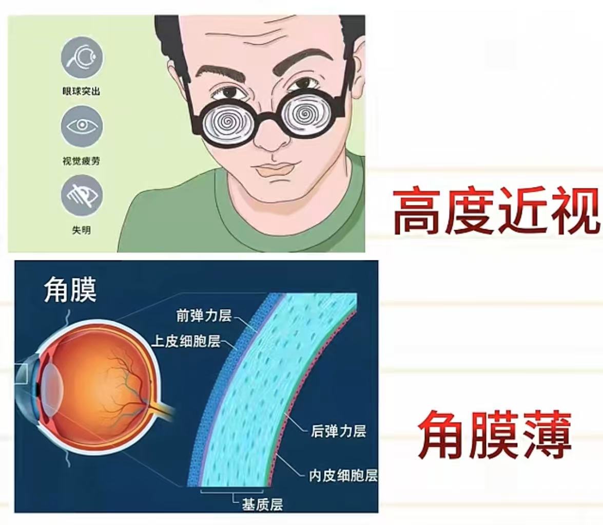 有片｜想做近視手術，全飛秒、半飛秒、晶體植入ICL哪個好？